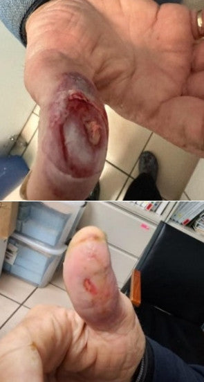 AMNIOTIC MENBRANE "PATCHES"